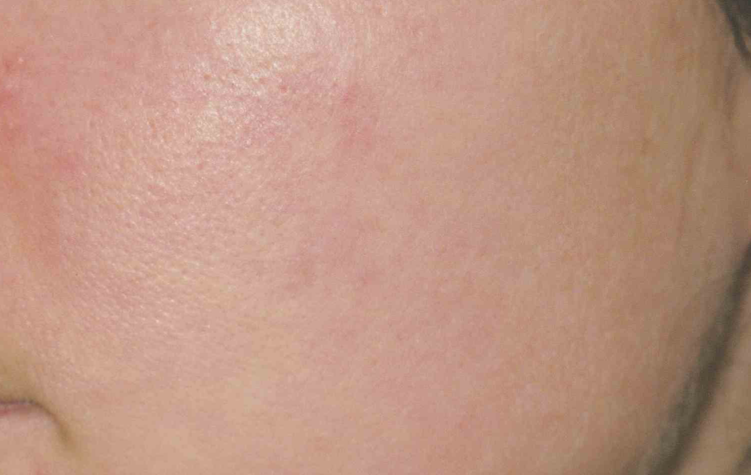 Hydroquinone for Treating Hyperpigmentation and Sun damaged Skin