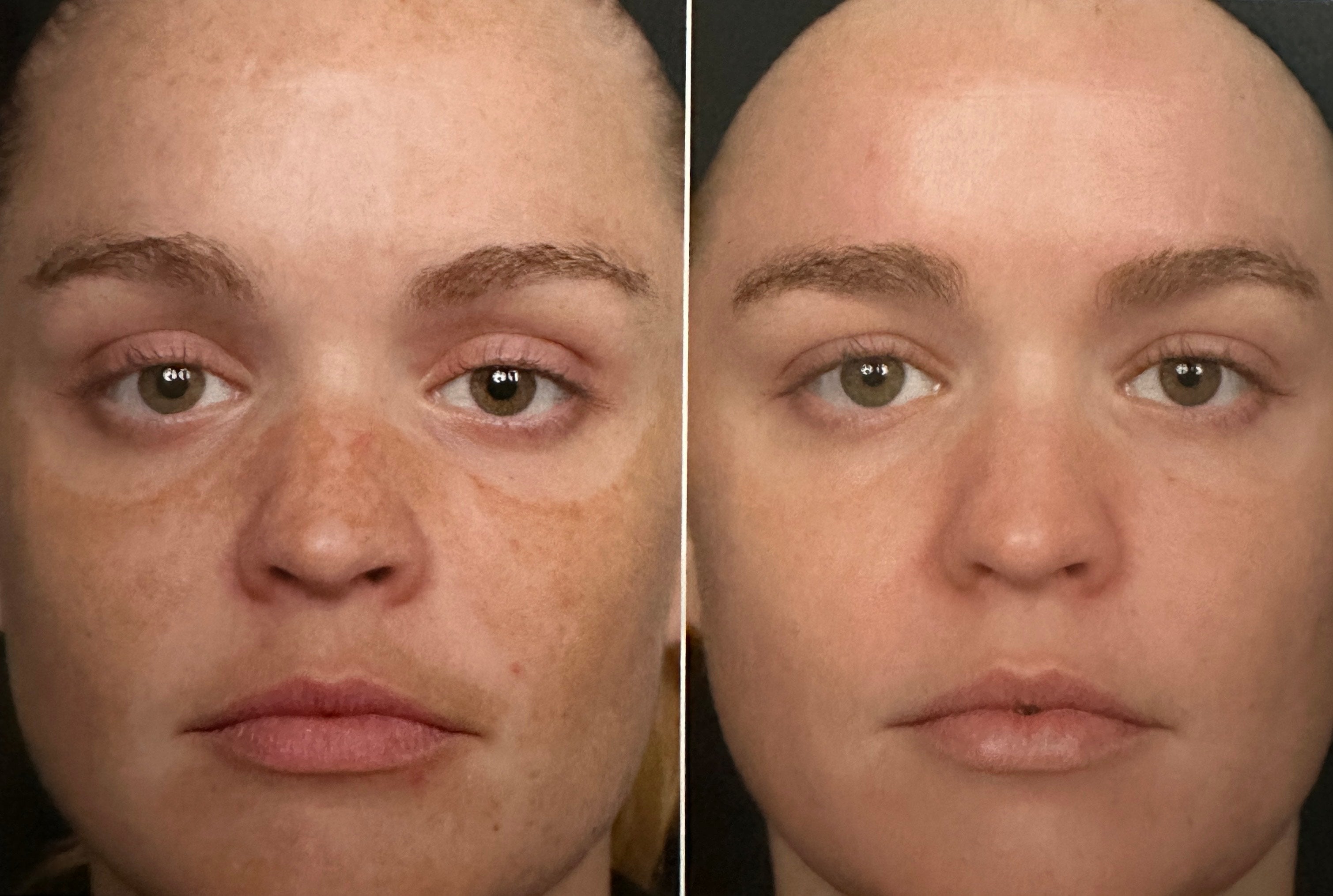 Surgeon General: Tanned Skin Is Damaged Skin