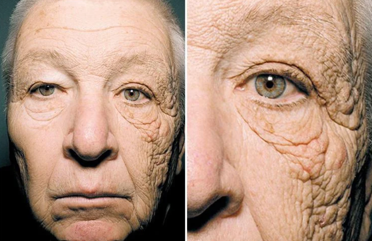 Overexposure to UV Radiation