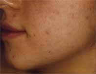 Anti Acne Skin