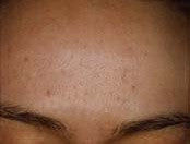 Anti Acne Protocol Results