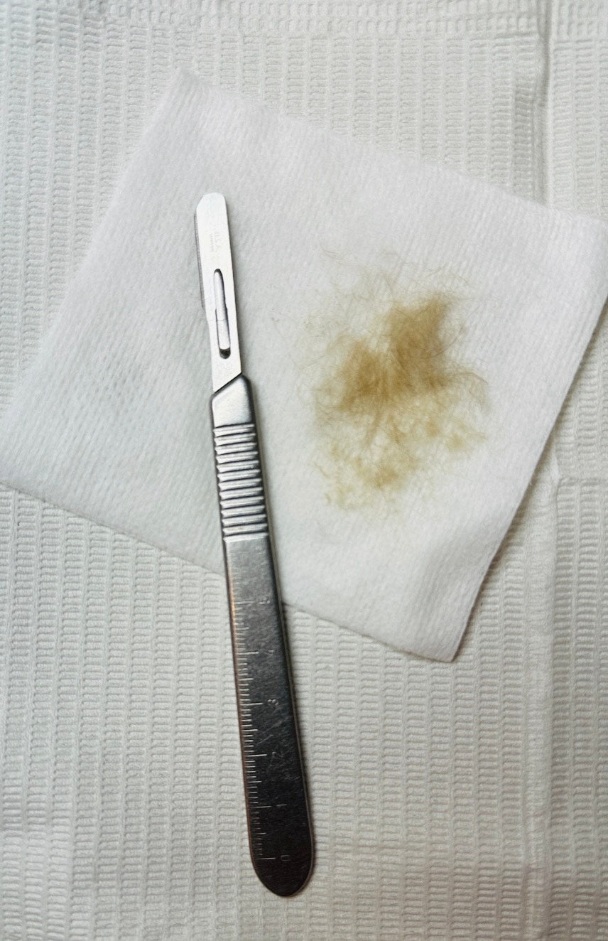 Dermaplaning Matters Before Extractions and Chemical Peels: The Science Behind Optimal Results in San Francisco