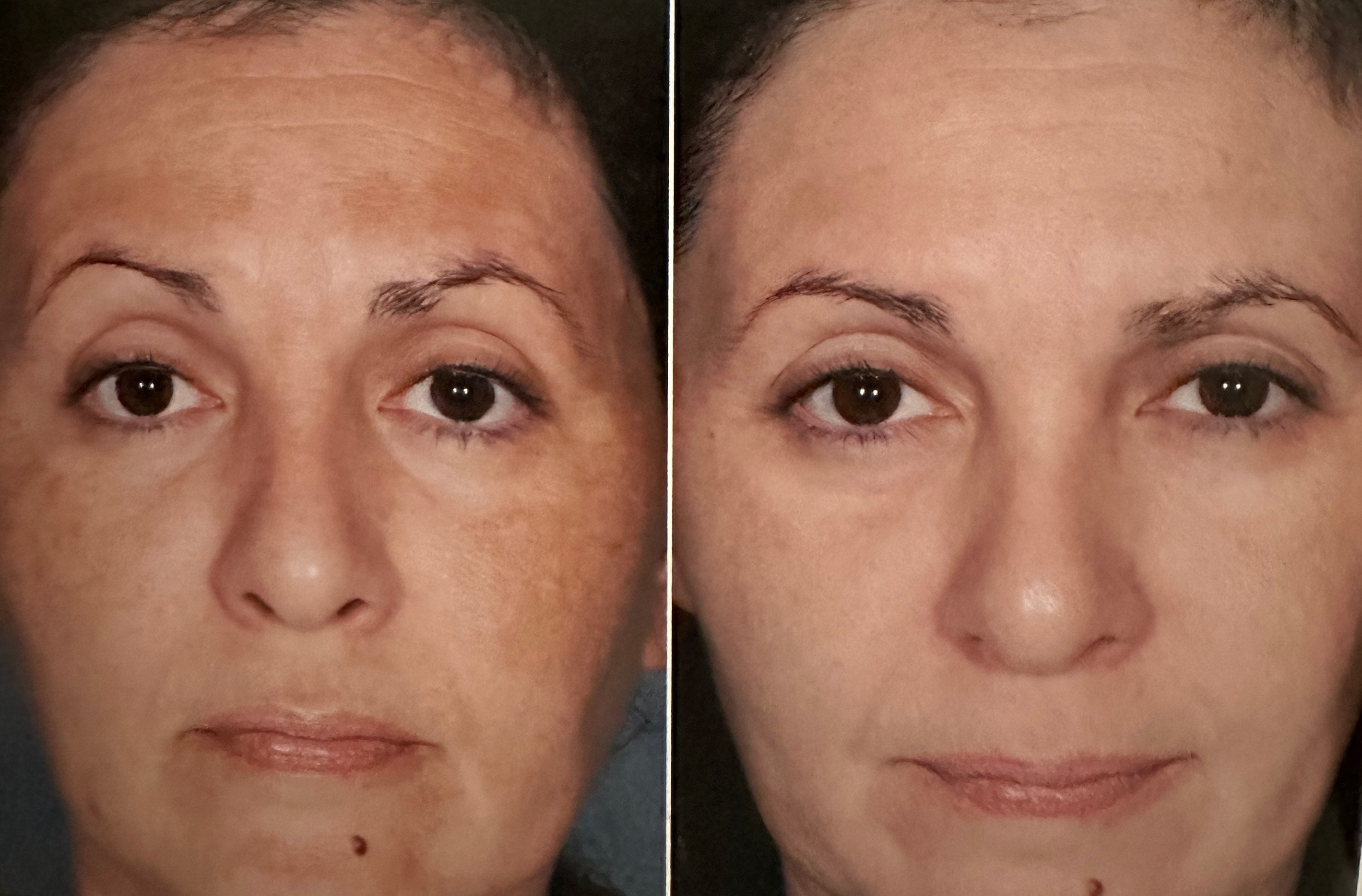 Obagi Nu-Derm Full Kit and Starter Kits Rx