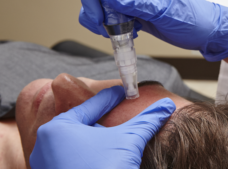 Why SkinPen Elite is the Superior Microneedling Device