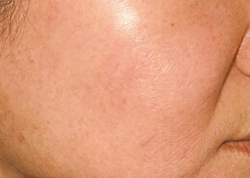 Transforming Skin Texture For a Healthier, Brighter Complexion